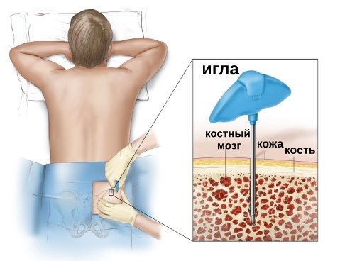Стоимость костного мозга: интересные факты
